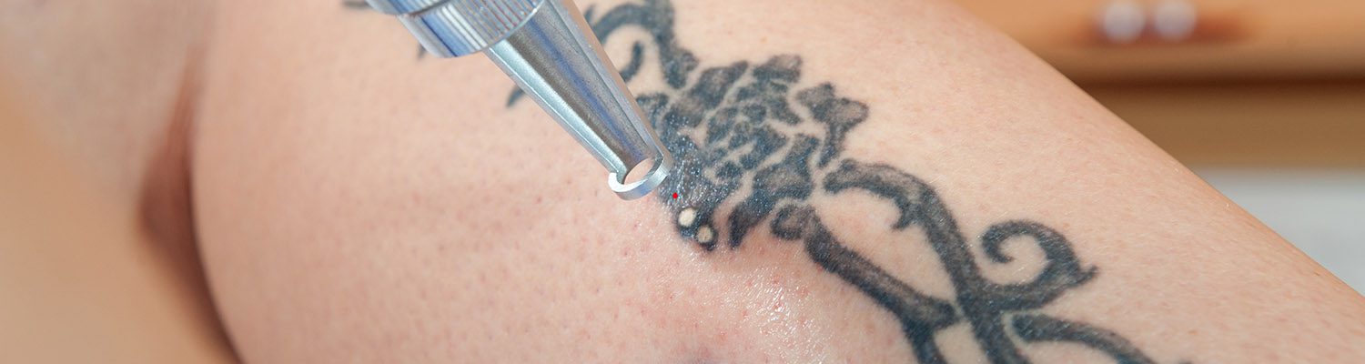 laser tattoo removal