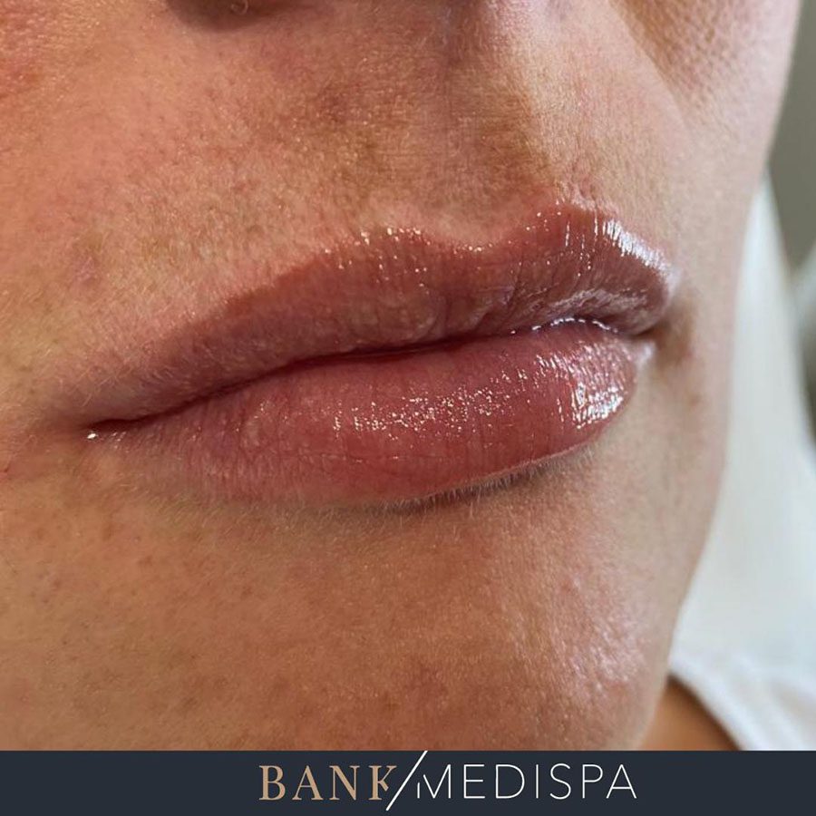 Lip enhancement results from bank Medispa