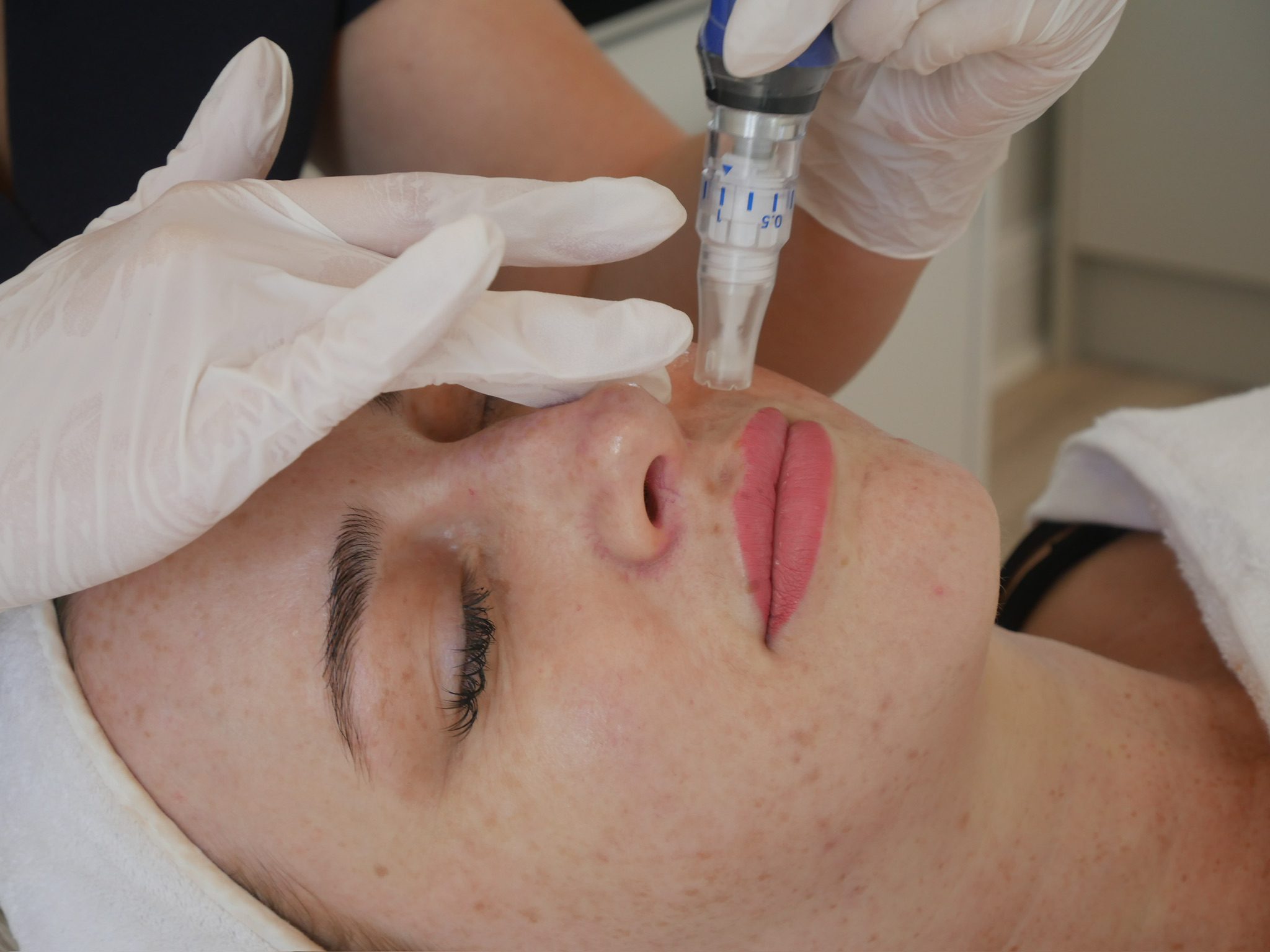 SKINPEN Microneedling Hale, Cheshire